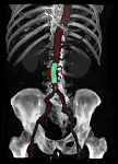 Abdominal Stenting